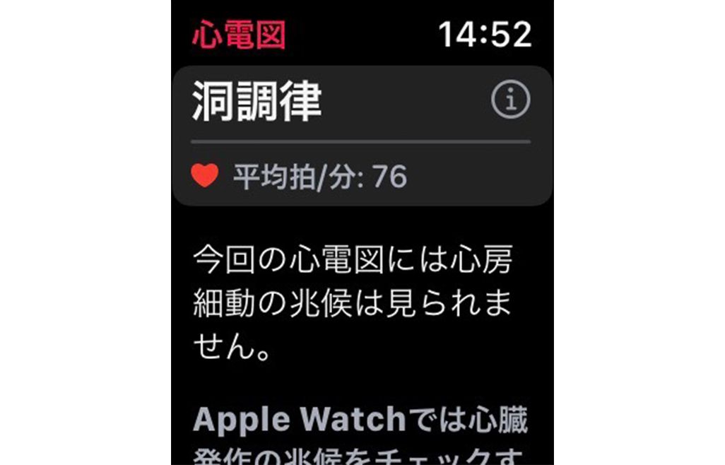 Apple Watchの心電図機能